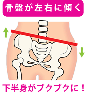 骨盤が左右に傾いた状態